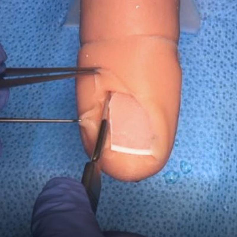 Ingrown Toenail Surgery Simulator - Replacement toenails - 10 pack - Medimodels