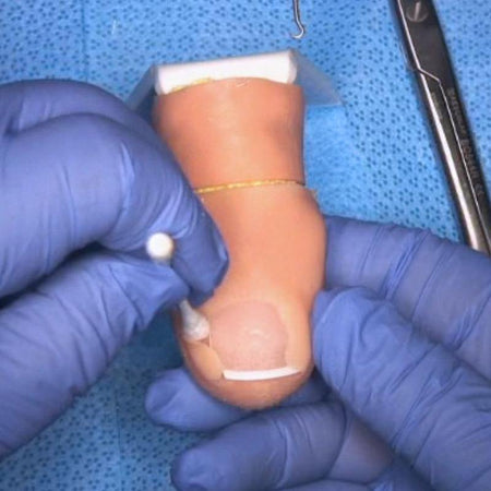 Ingrown toenail surgical simulator - Medimodels